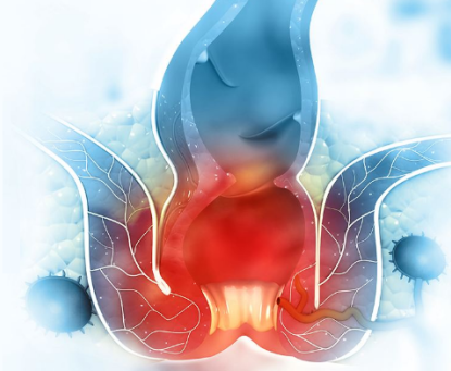 Có những dấu hiệu nào cho thấy áp xe hậu môn đã tái phát?